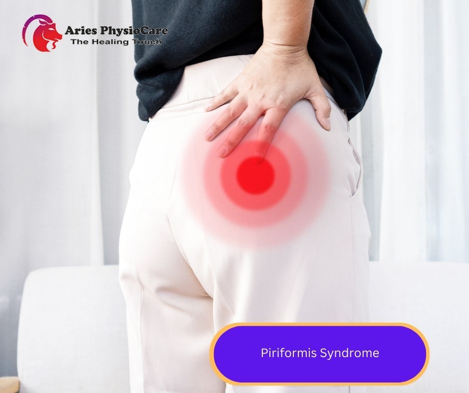 Piriformis Syndrome Aries Physiocare