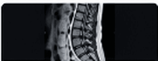 Physiotherapy vs. Surgery for Disc Problems