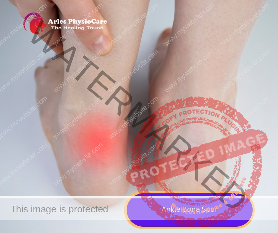 Ankle Bone Spur Ankle Bone Spur