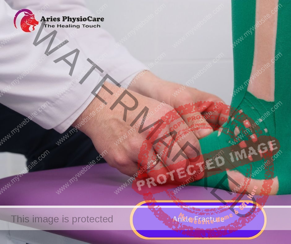 Ankle Fracture Ankle Fracture
