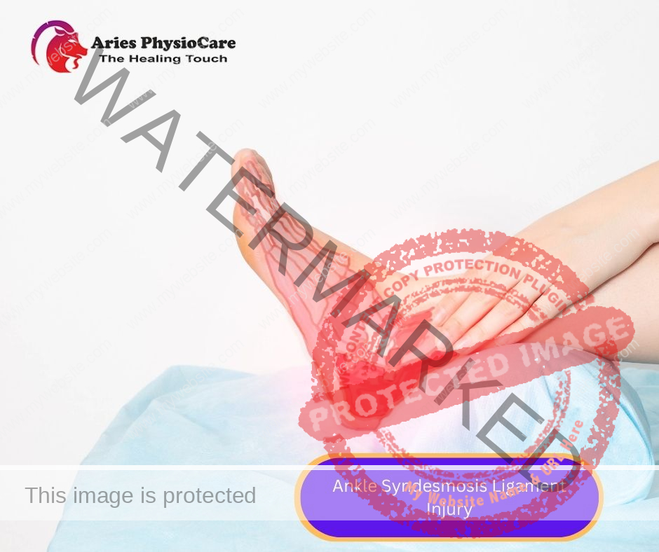 Ankle Syndesmosis Ligament Injury Ankle Syndesmosis Ligament Injury
