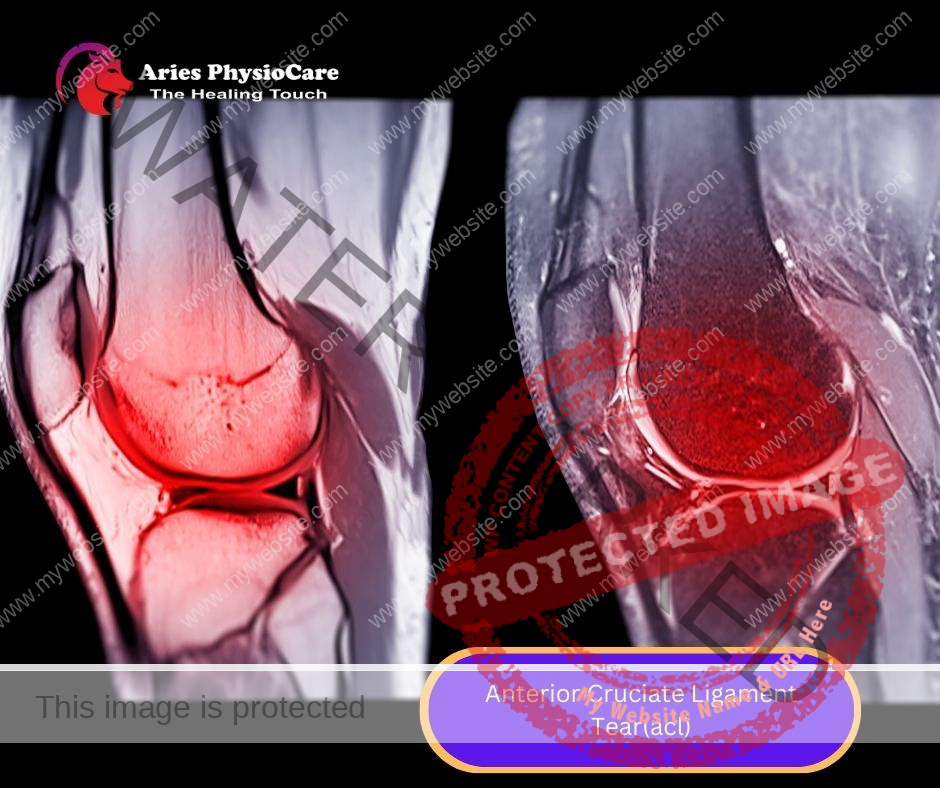 Anterior Cruciate Ligament Tear(acl) Anterior Cruciate Ligament Tear(acl)