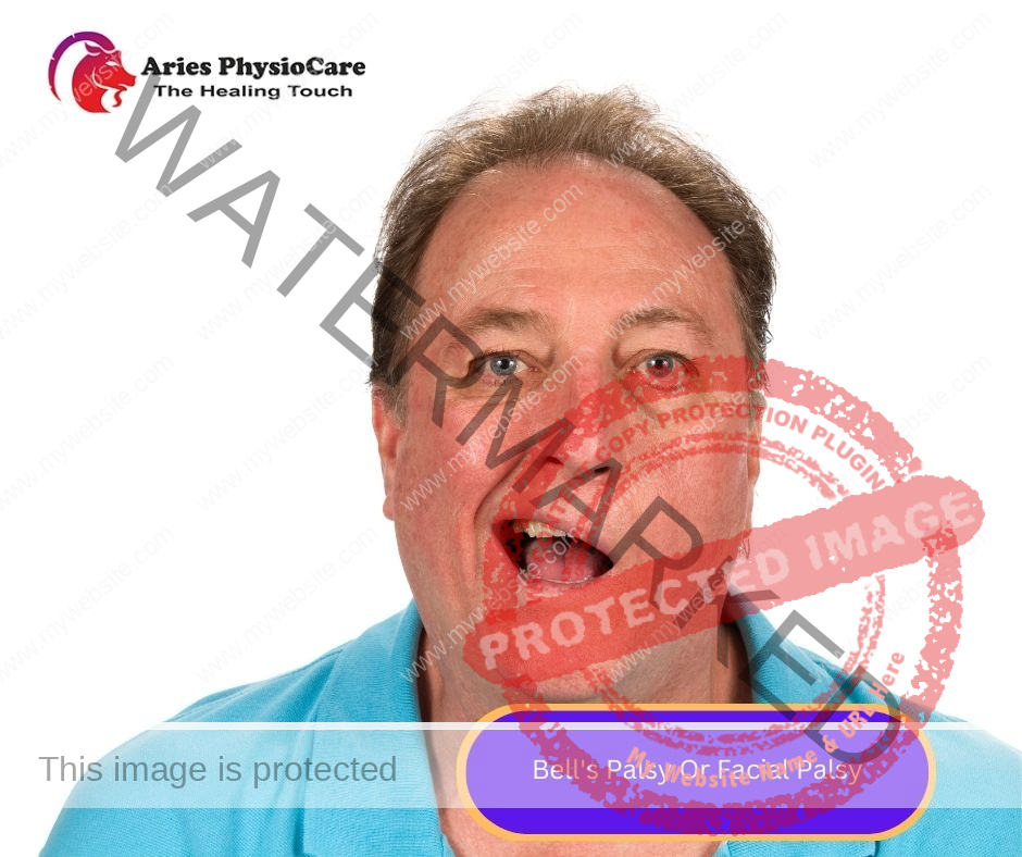 Bell's Palsy Or Facial Palsy Bell's Palsy Or Facial Palsy