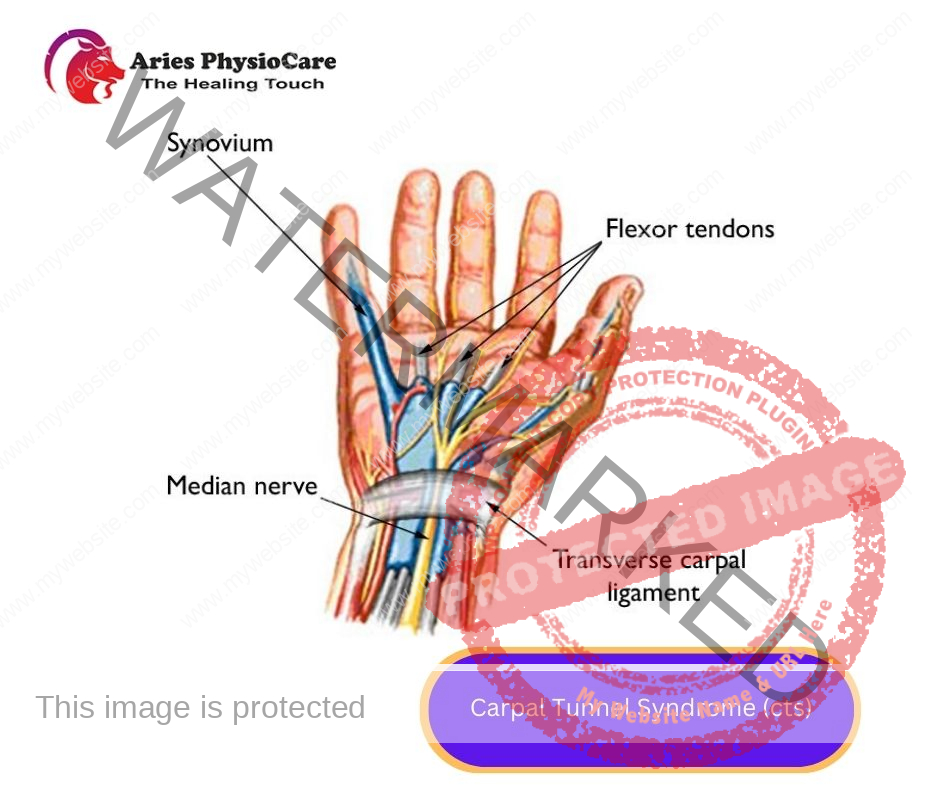 Carpal Tunnel Syndrome (cts) Carpal Tunnel Syndrome (cts)