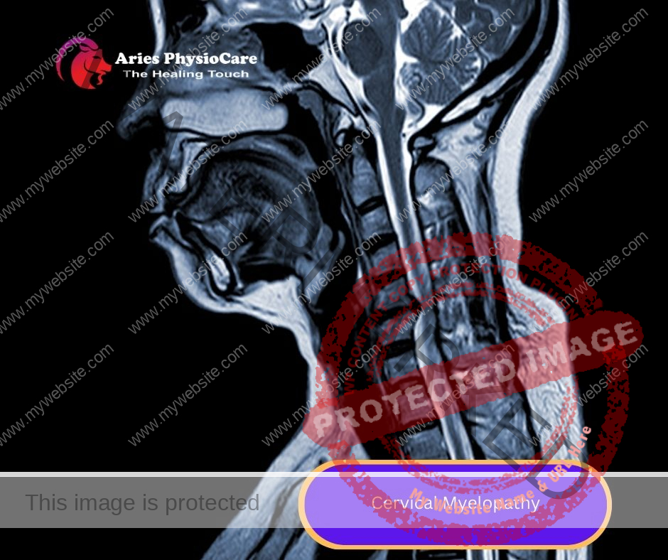 Cervical Myelopathy Cervical Myelopathy