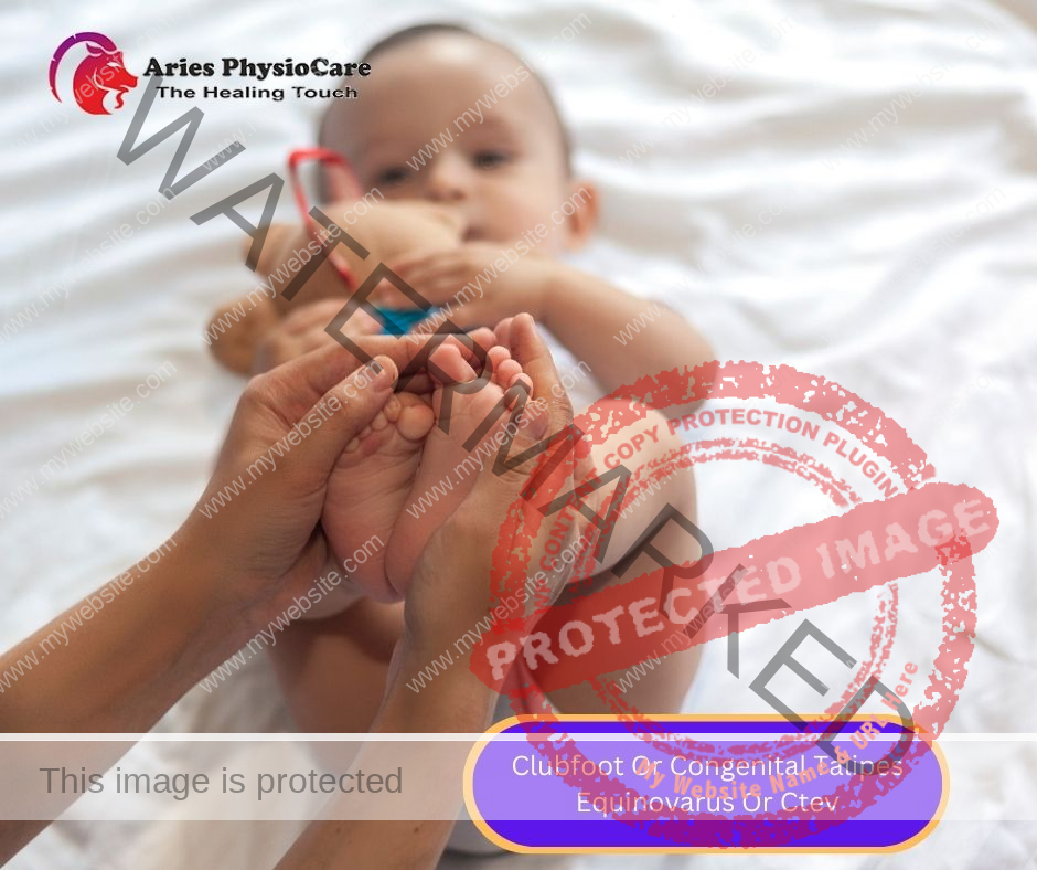 Clubfoot Or Congenital Talipes Equinovarus Or Ctev Clubfoot Or Congenital Talipes Equinovarus Or Ctev