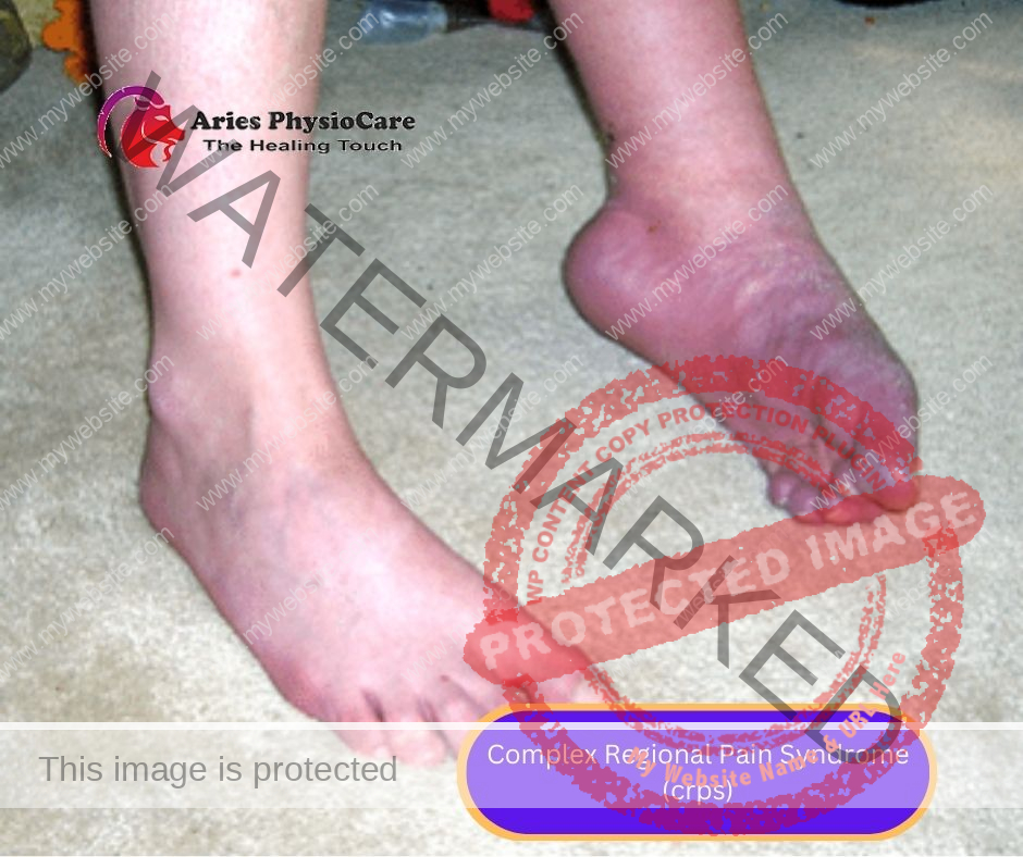 Complex Regional Pain Syndrome (crps) Complex Regional Pain Syndrome (crps)