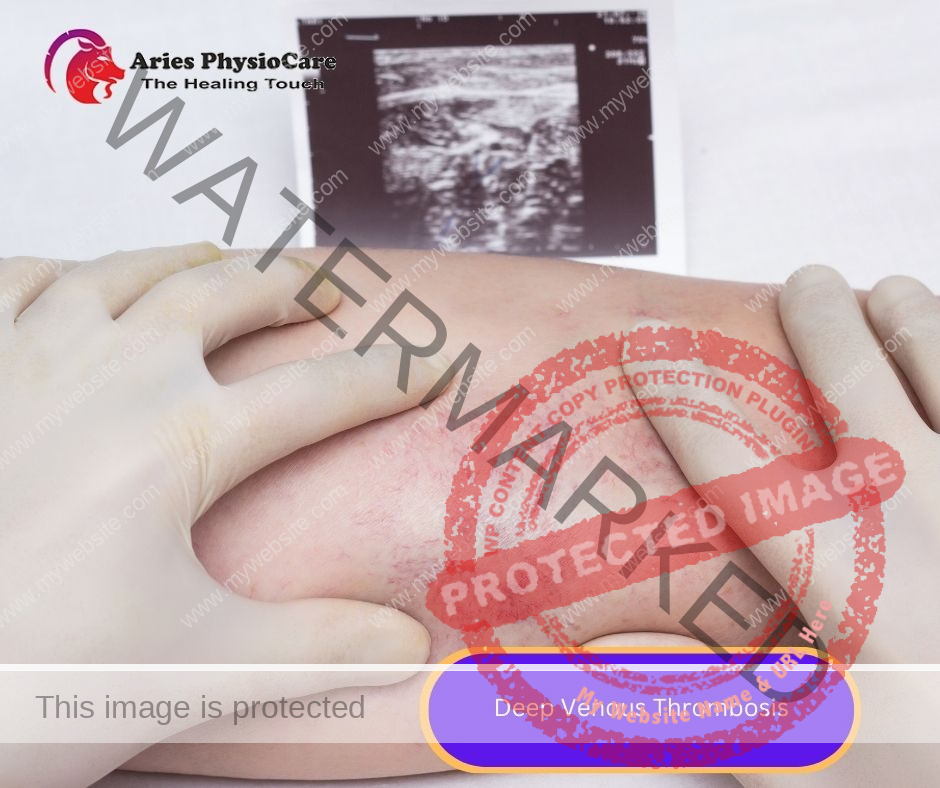 Deep Venous Thrombosis Deep Venous Thrombosis