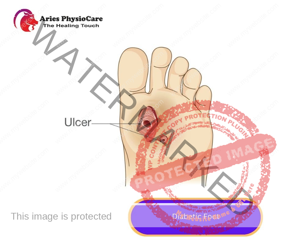 Diabetic Foot Diabetic Foot