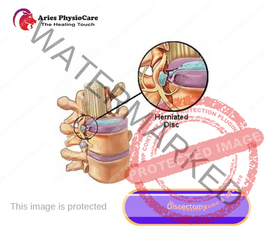 Discectomy Discectomy