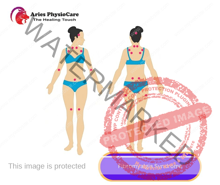 Fibromyalgia Syndrome Fibromyalgia Syndrome