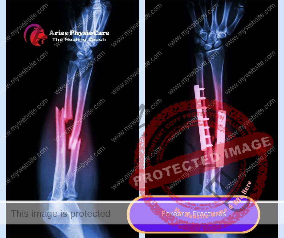 Forearm Fractures Forearm Fractures