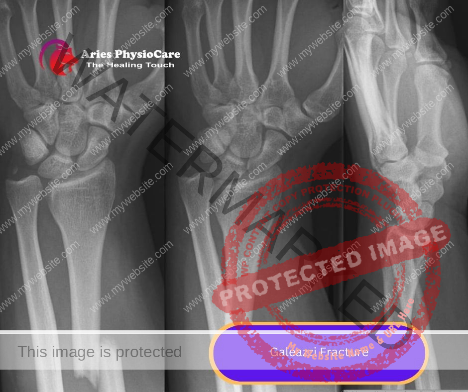 Galeazzi Fracture Galeazzi Fracture