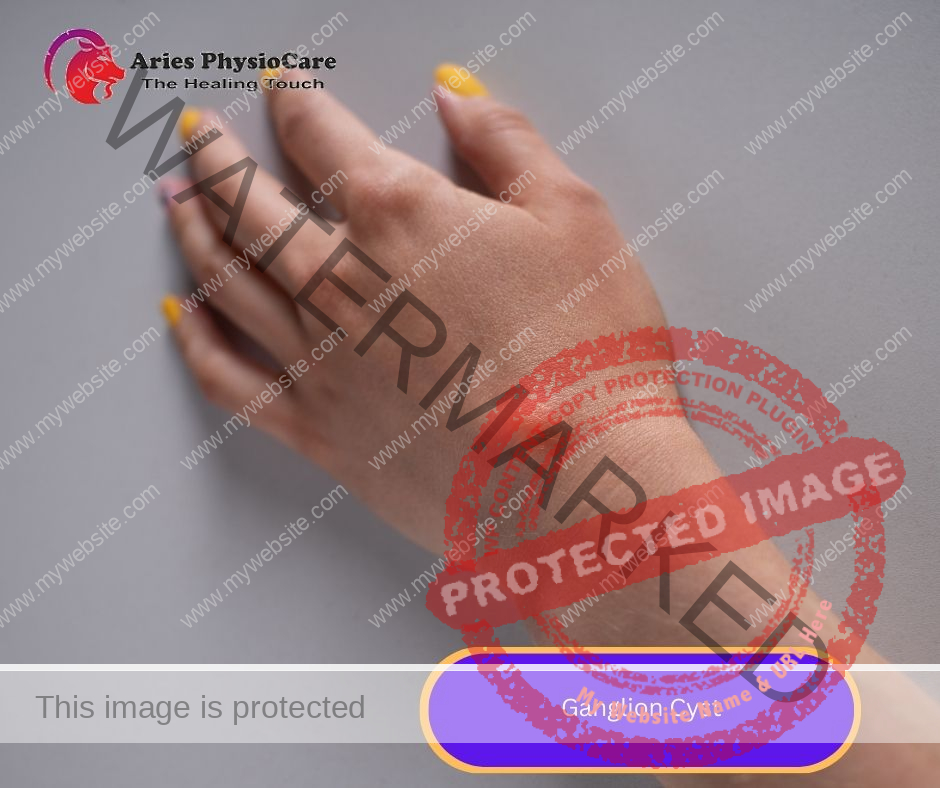 Ganglion Cyst Ganglion Cyst