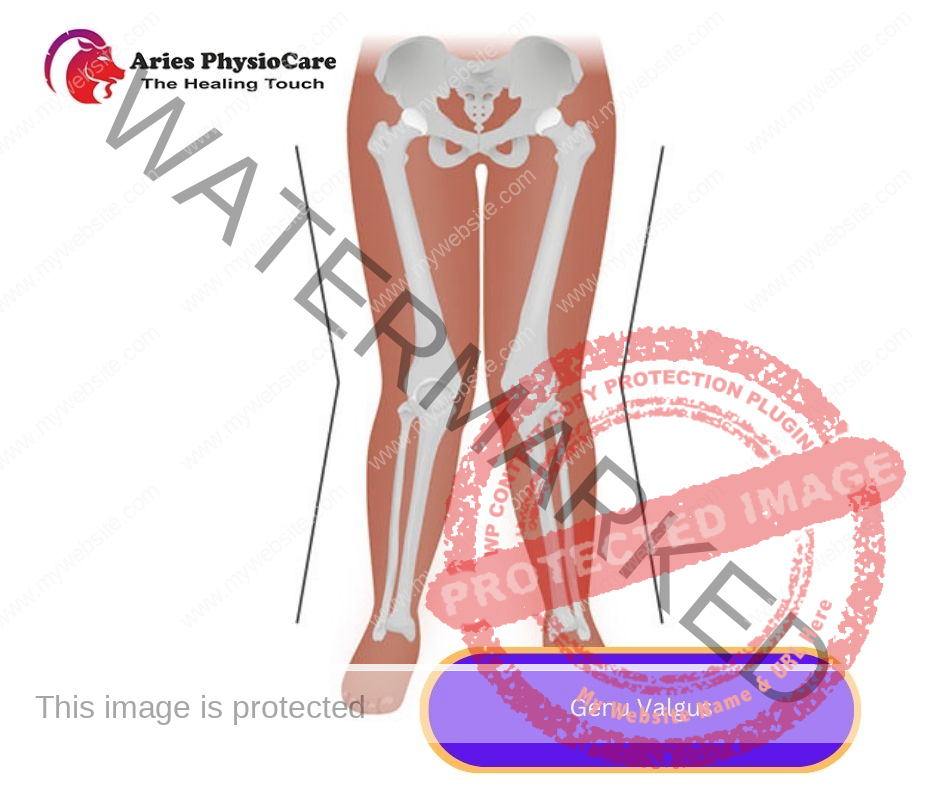 Genu Valgus Genu Valgus