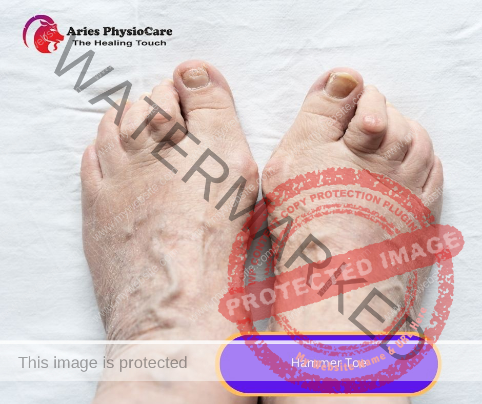Hammer Toe Hammer Toe