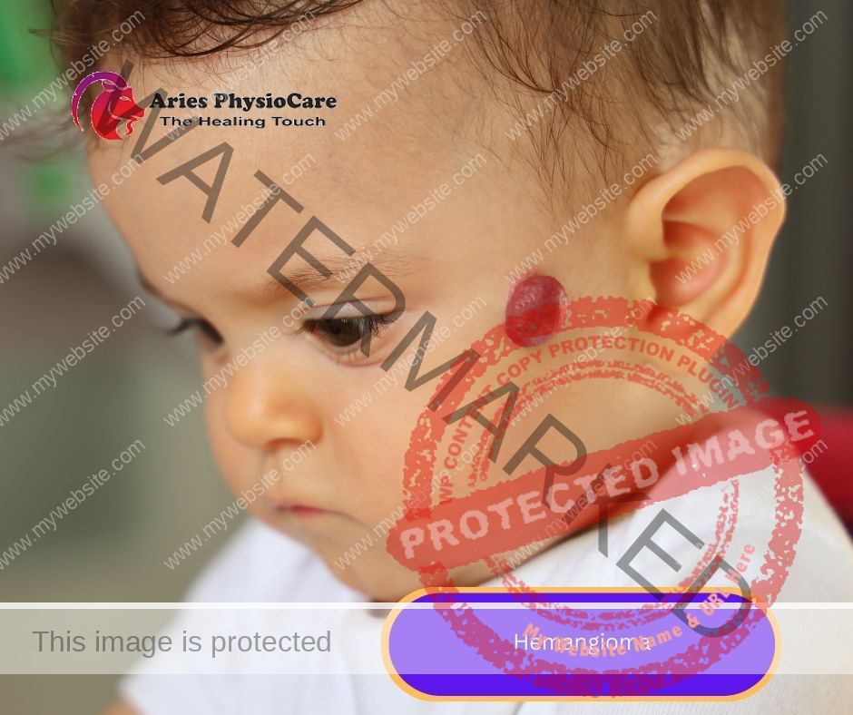 Hemangioma Hemangioma