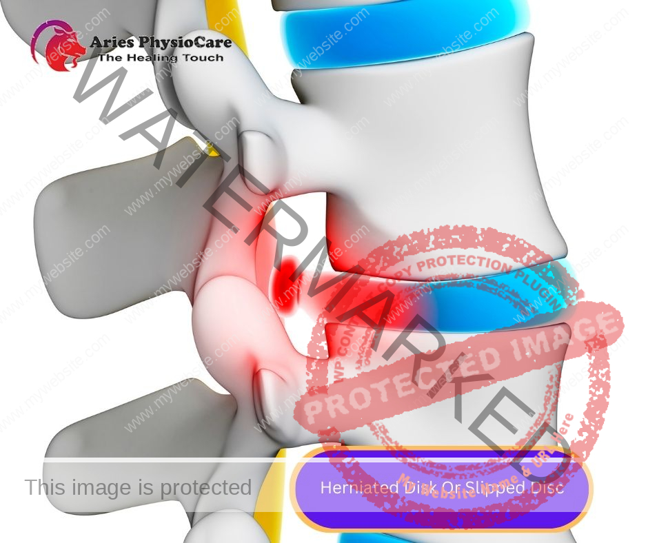 Herniated Disk Or Slipped Disc Herniated Disk Or Slipped Disc