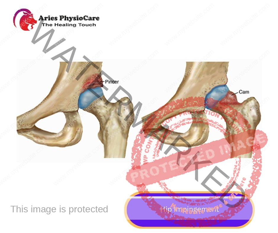 Hip Impingement Hip Impingement