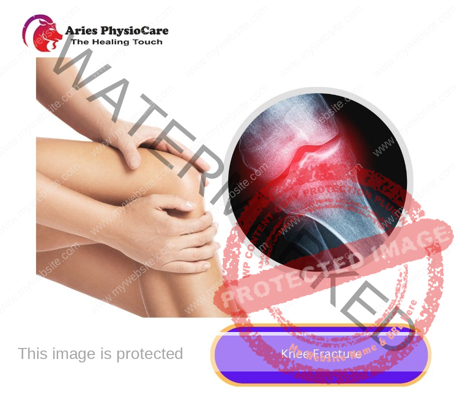 Knee Fracture Knee Fracture