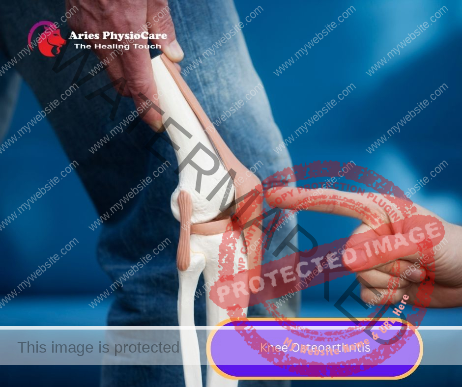 Knee Osteoarthritis Knee Osteoarthritis