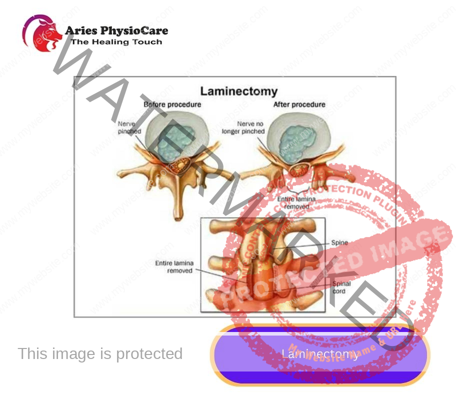 Laminectomy Laminectomy