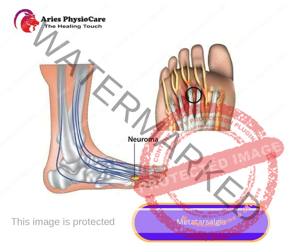 Metatarsalgia Metatarsalgia
