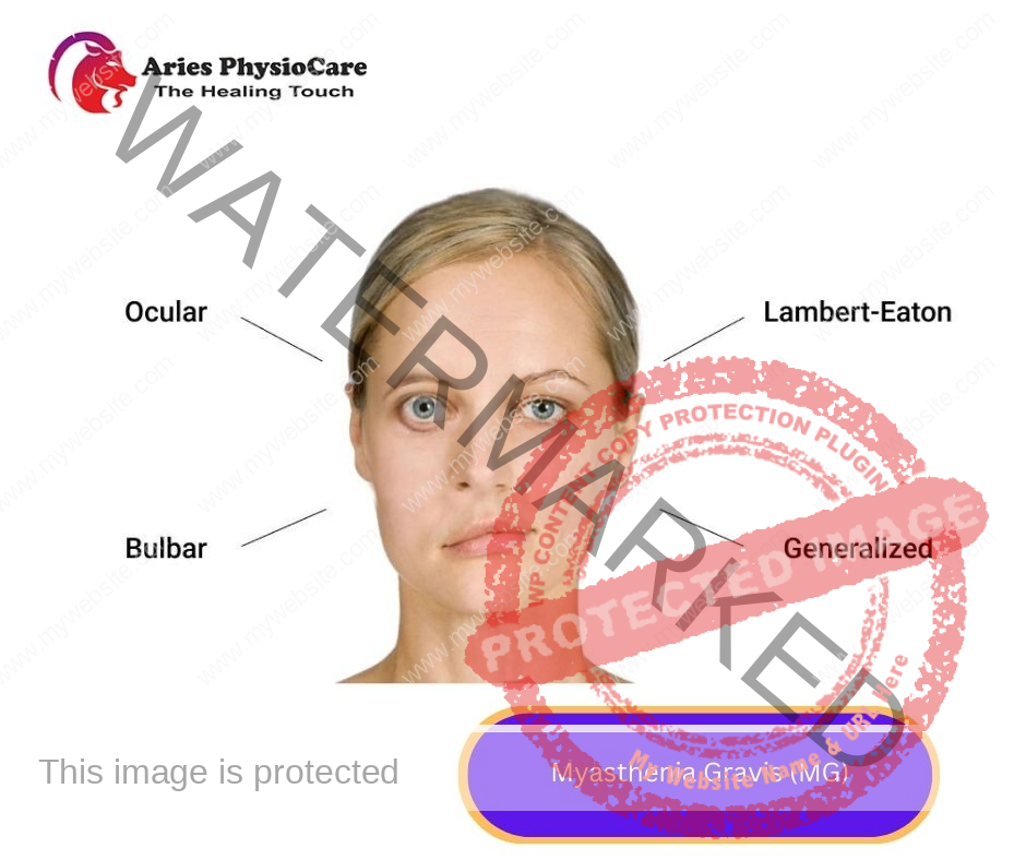 Myasthenia Gravis (mg) Myasthenia Gravis (mg)