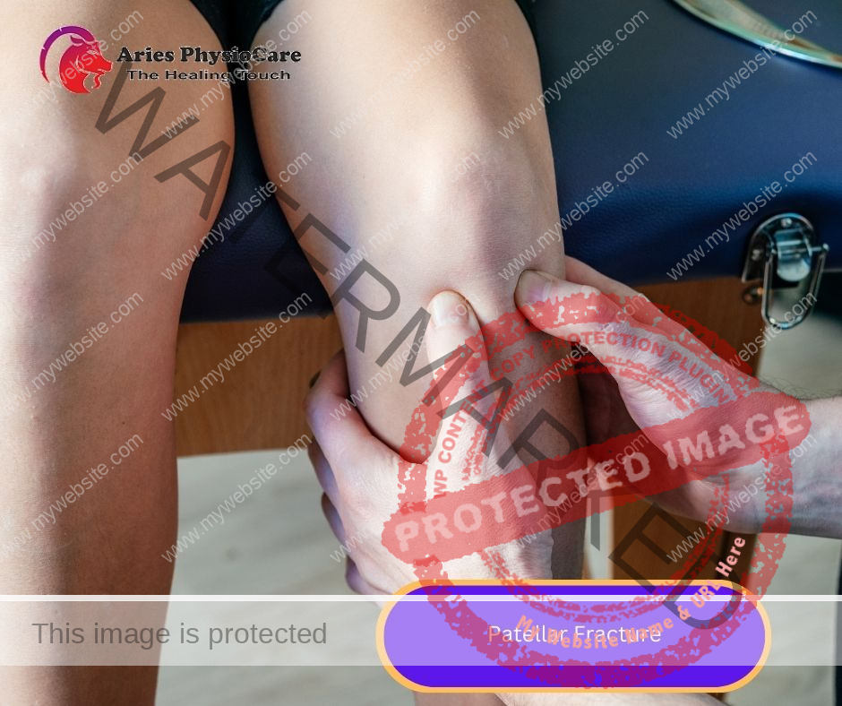 Patellar Fracture Patellar Fracture