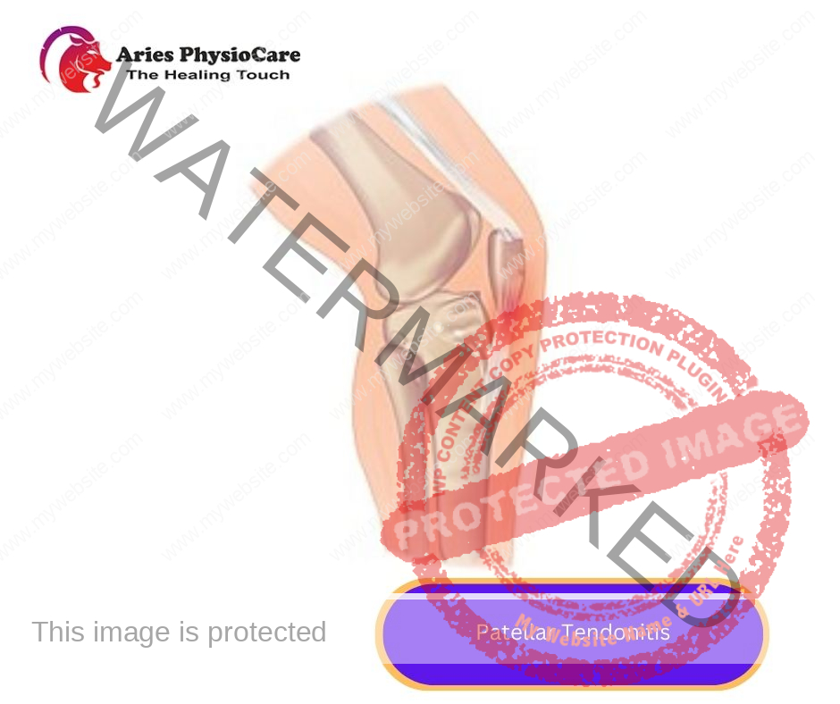 Patellar Tendonitis Patellar Tendonitis
