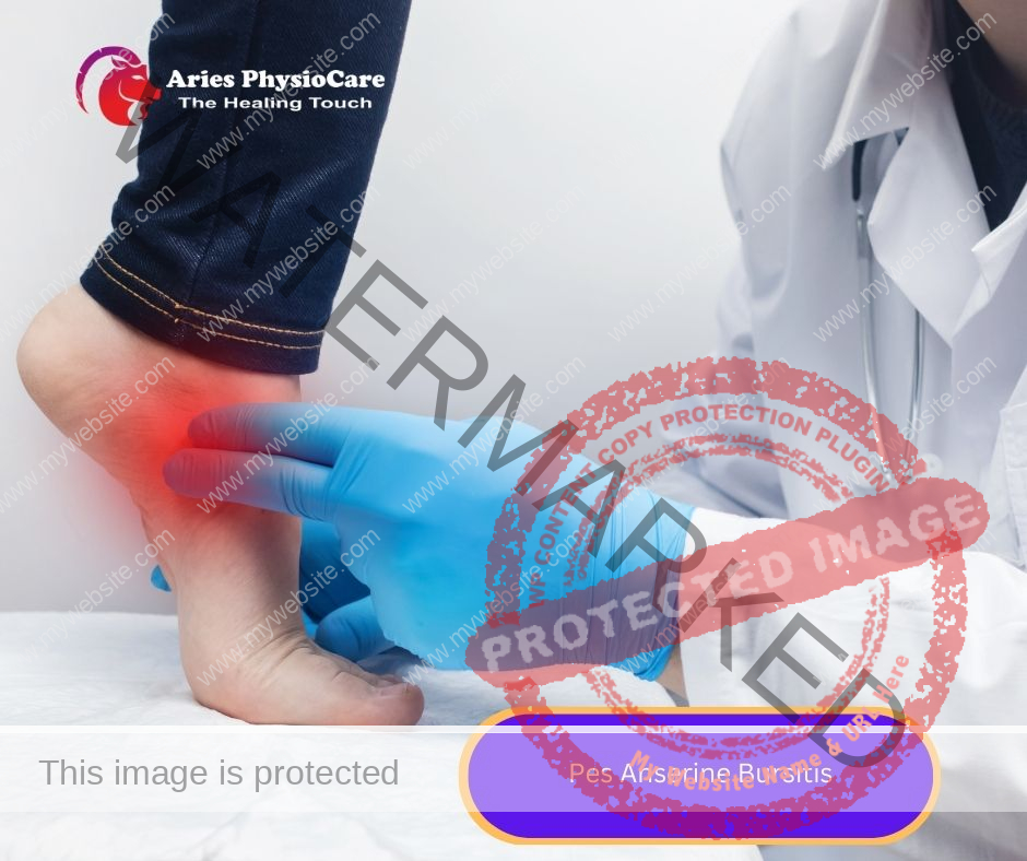Pes Anserine Bursitis Pes Anserine Bursitis