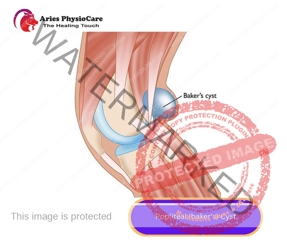 Popliteal (baker's) Cyst Popliteal (baker's) Cyst