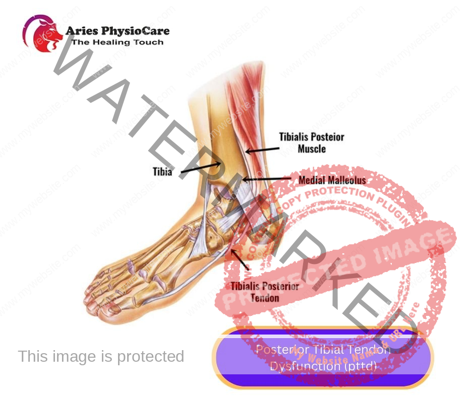 Posterior Tibial Tendon Dysfunction (pttd) Posterior Tibial Tendon Dysfunction (pttd)