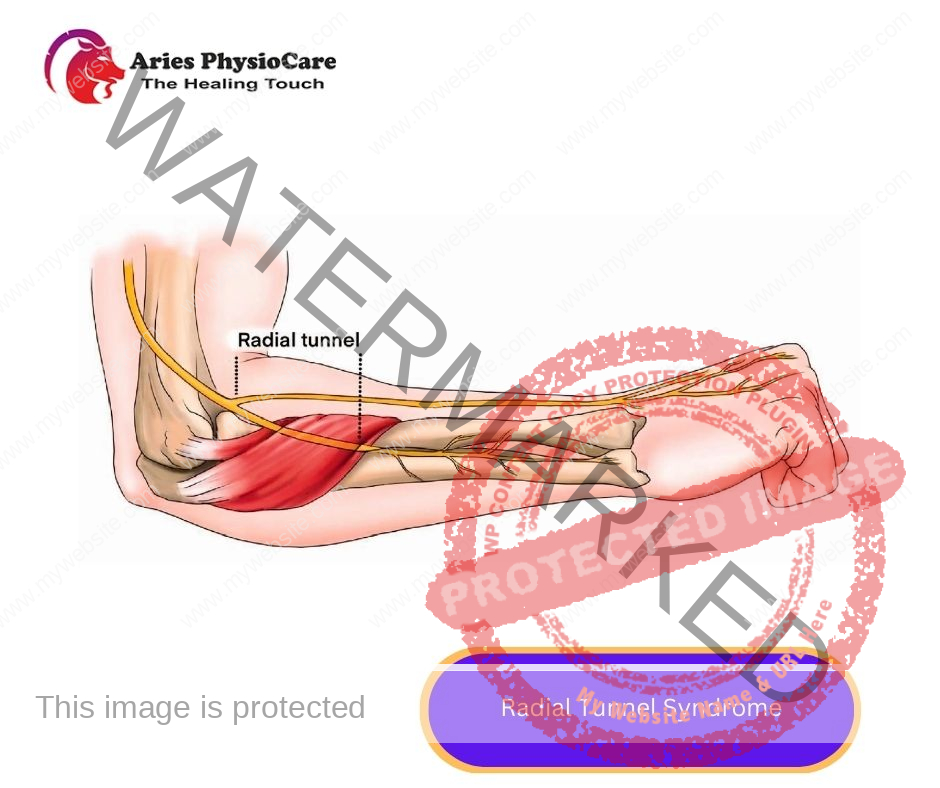 Radial Tunnel Syndrome Radial Tunnel Syndrome