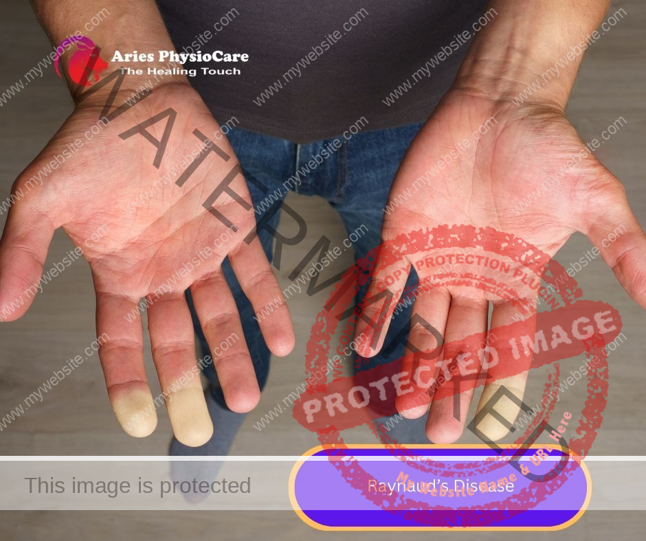 Raynaud’s Disease Raynaud’s Disease