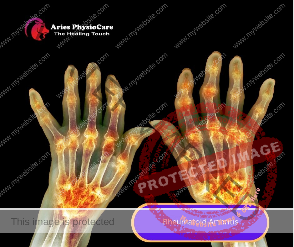 Rheumatoid Arthritis Rheumatoid Arthritis