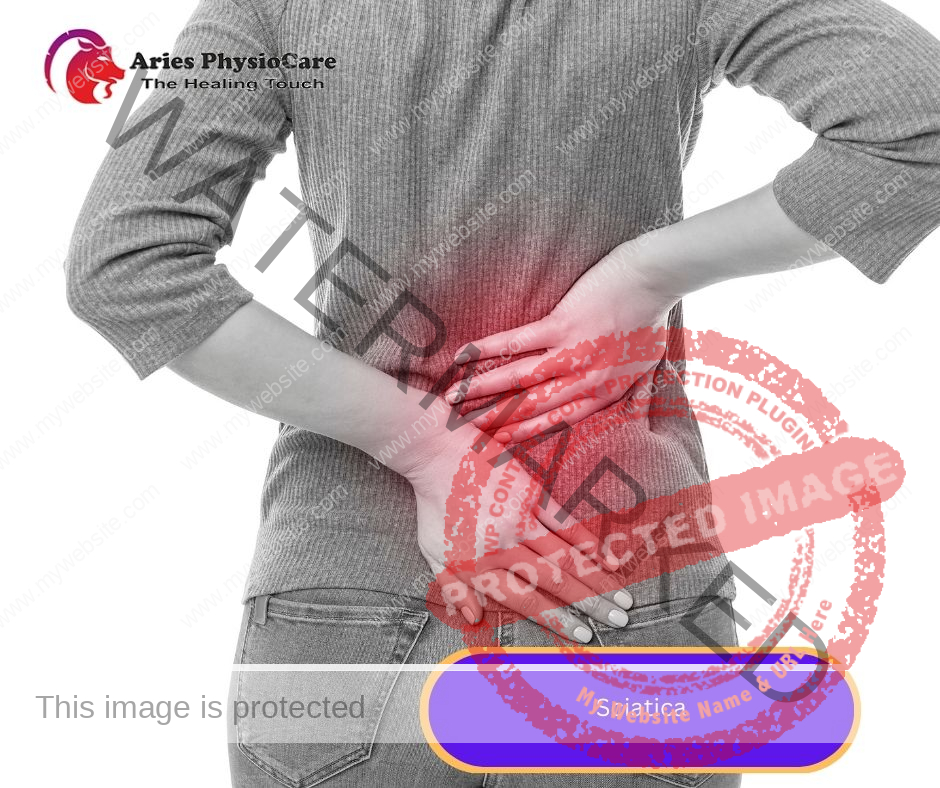 Sciatica Sciatica