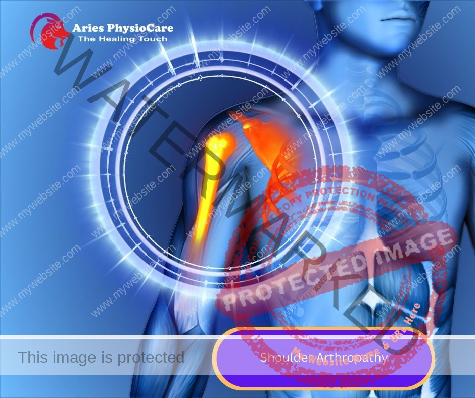Shoulder Arthropathy Shoulder Arthropathy