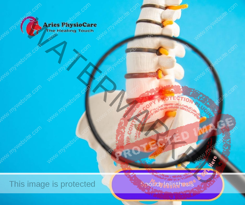 Spondylolisthesis Spondylolisthesis