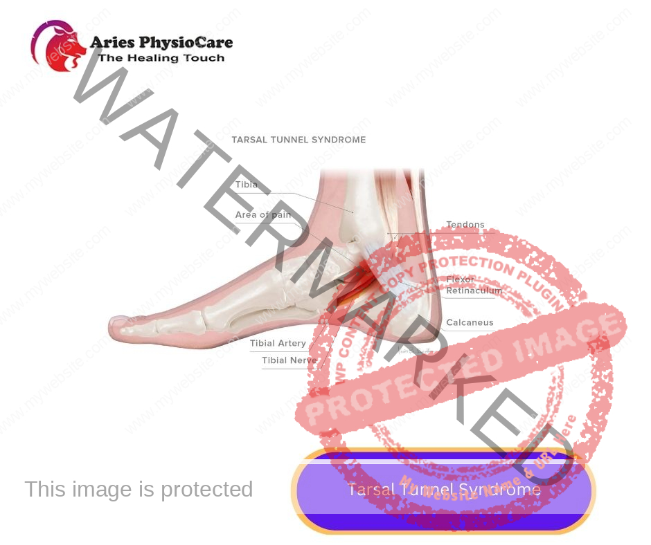 Tarsal Tunnel Syndrome Tarsal Tunnel Syndrome