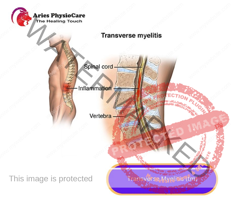 Transverse Myelitis (tm) Transverse Myelitis (tm)