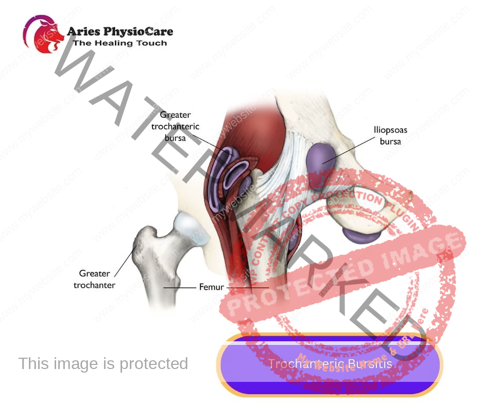 Trochanteric Bursitis Trochanteric Bursitis