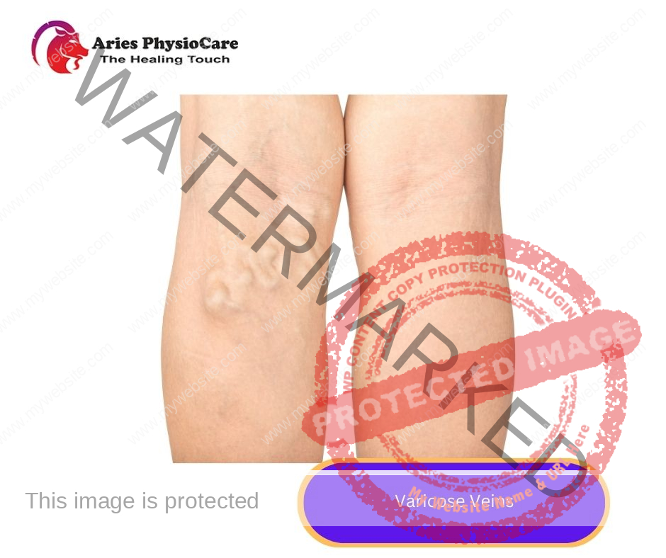 Varicose Veins Varicose Veins