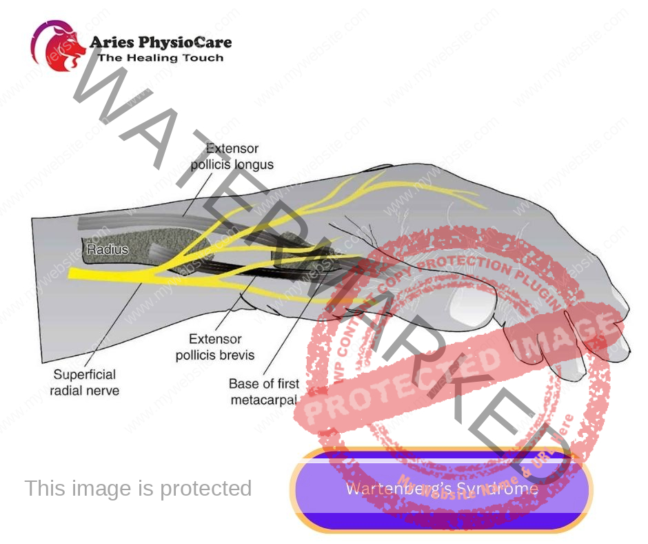 Wartenberg’s Syndrome Wartenberg’s Syndrome